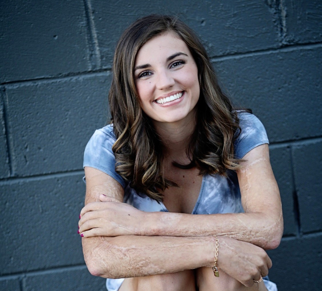 Kilee Brookbank with scars on arms and legs smiling at camera