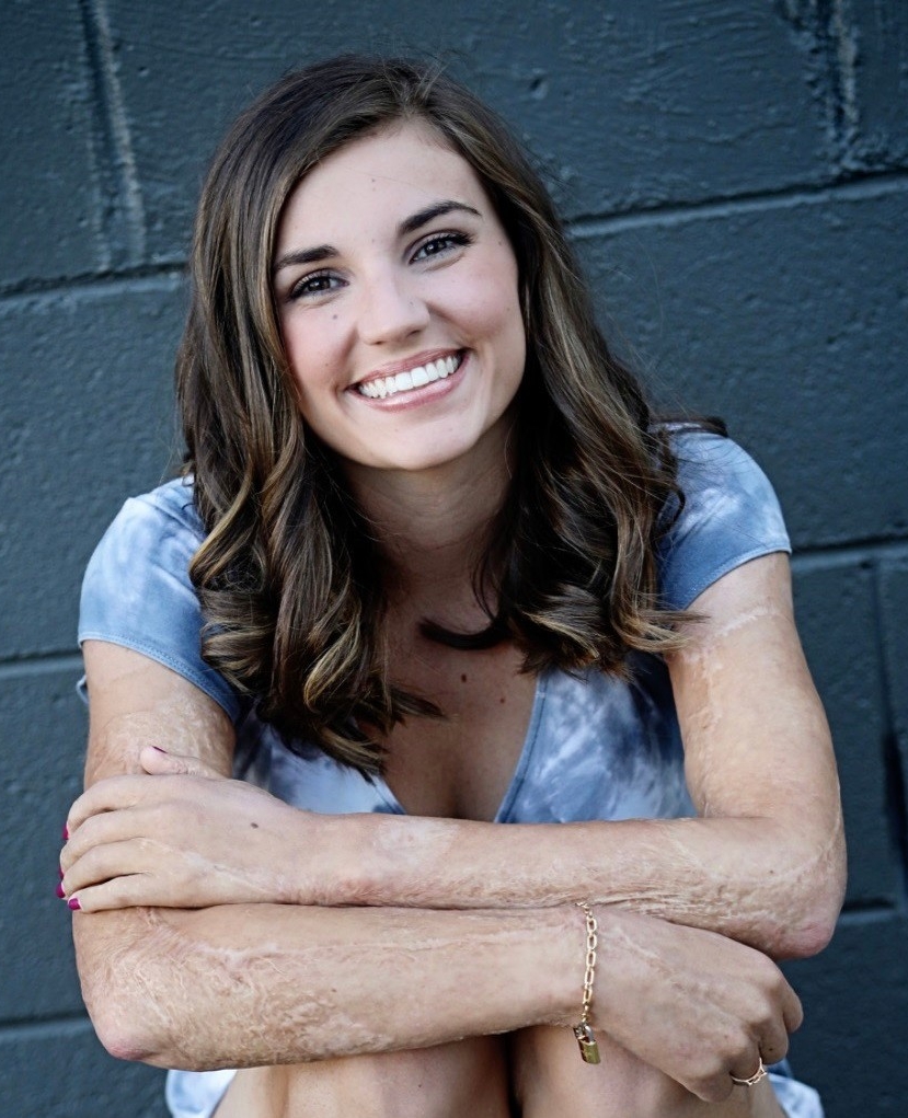 Kilee Brookbank with scars on arms and legs smiling at camera
